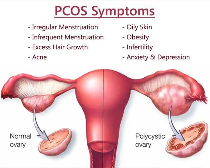 PCOS
